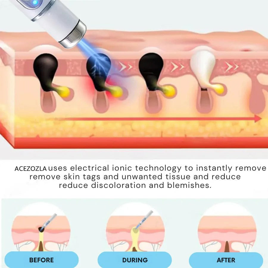 Say goodbye to moles and skin tags! ACEZOZLA™ non-invasive laser pen delivers hospital-grade results at home