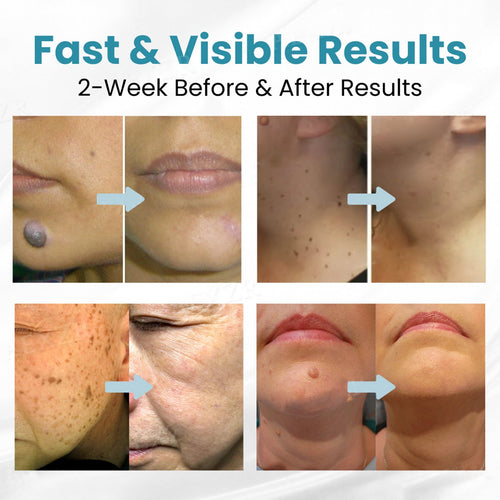 Say goodbye to moles and skin tags! ACEZOZLA™ non-invasive laser pen delivers hospital-grade results at home